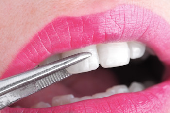 Lumineers Brand Dental Veneers