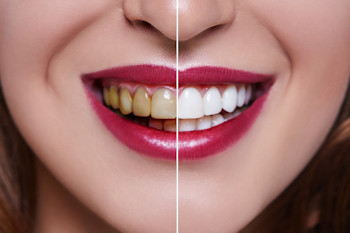 Zoom 2 Teeth Whitening