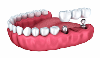 Dental Implant Specialists in Chandler