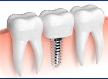 Dental Implant Dentists in Chandler