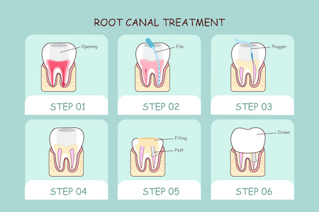 Illustration of root canal treatment