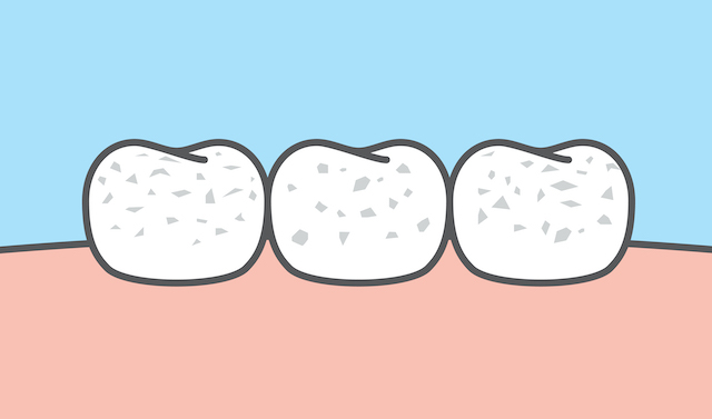 Illustration of white spots on teeth.