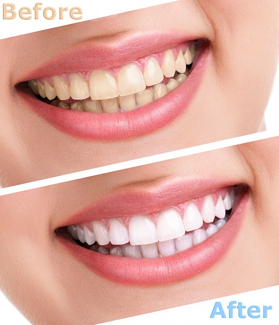 teeth whitenting to remove spots on teeth