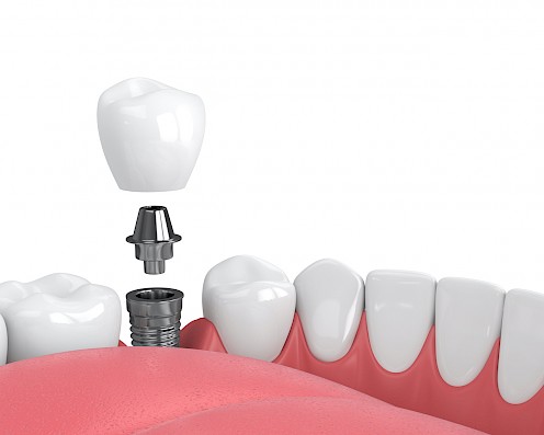 Illustration of a dental implant.