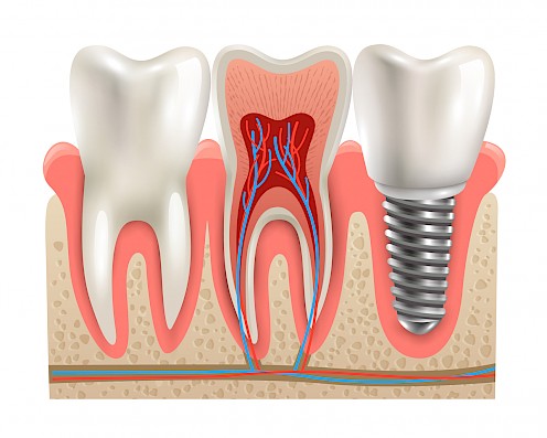 Dental implant illustration.