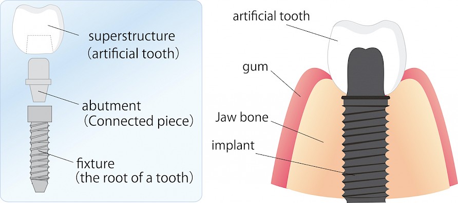 Parts of a dental implant.