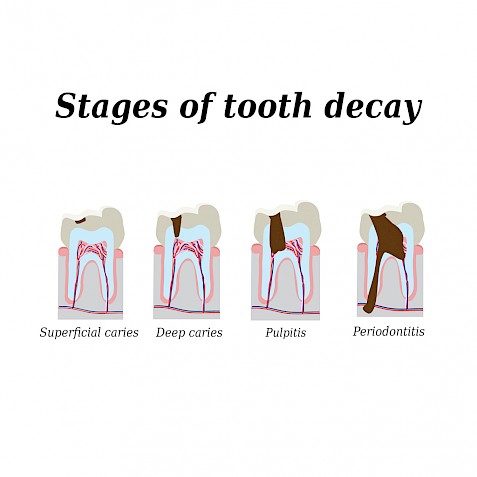 Stages of tooth decay.